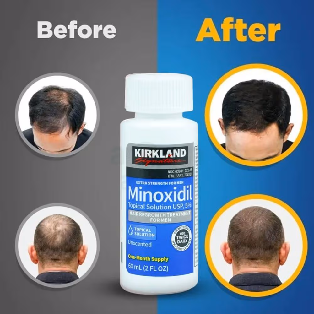 Original Minoxidil Hair Growth Solution for Men and Women
